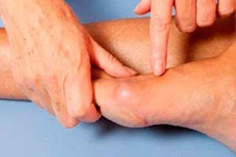 Inflamación e inflamación nas pernas antes de usar Hondrogel