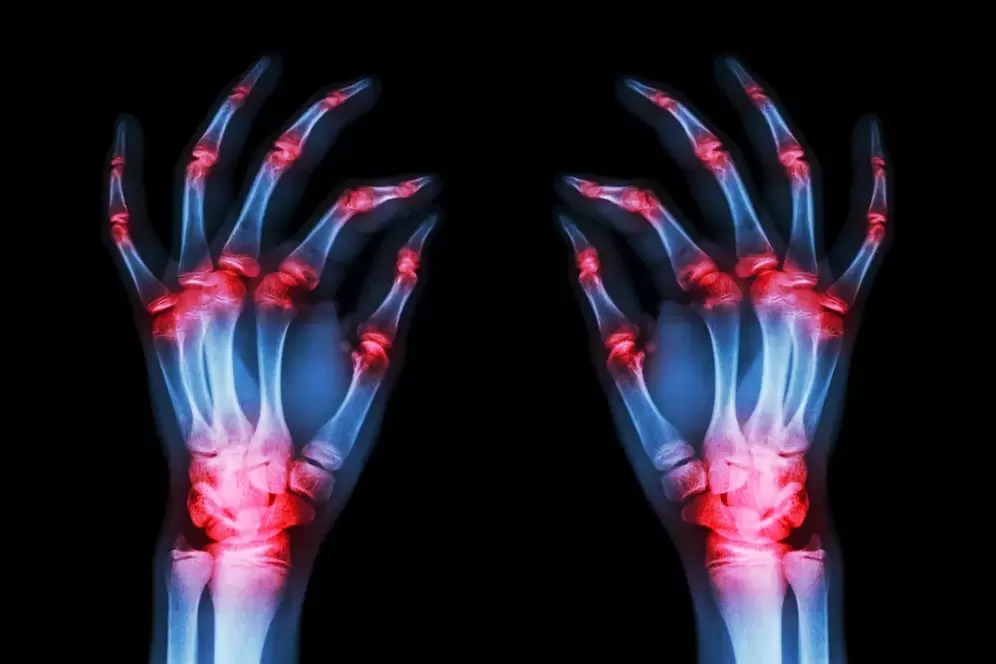 artrose das articulacións dos dedos