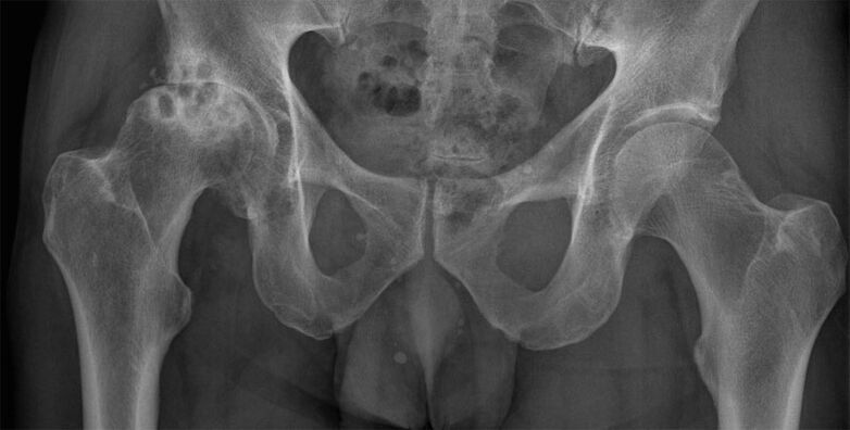 Artrose 3 da articulación da cadeira na radiografía