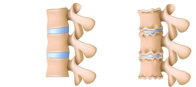 Osteocondrose desde dentro