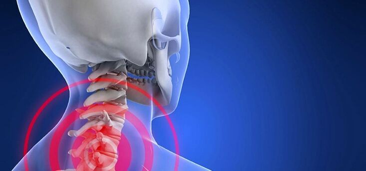 Osteocondrose da rexión cervical