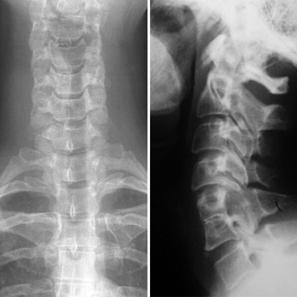 X -ray da columna cervical