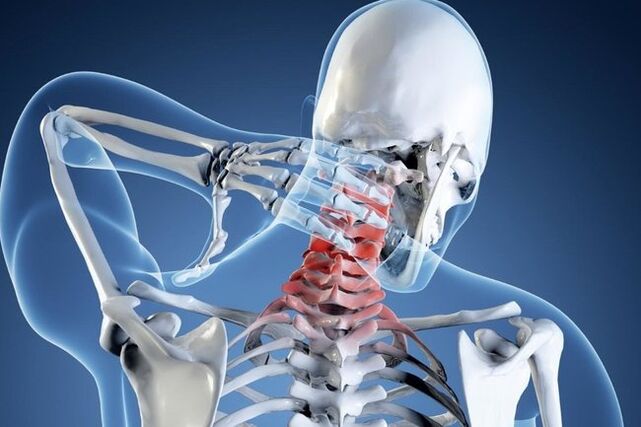 Osteocondrose da rexión cervical
