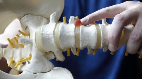 hernia da columna vertebral como causa de dor lumbar
