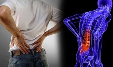 As razóns para o desenvolvemento da osteocondrose lumbar