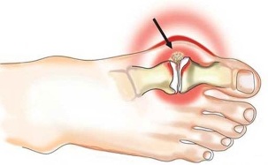 Inflamación da articulación entre o polgar e o pé na artrite