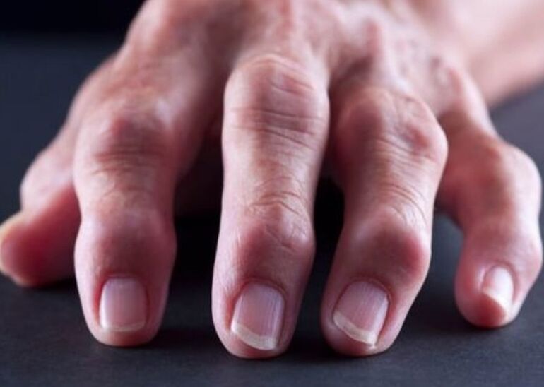 artrite reumatoide como causa de dor nas articulacións dos dedos
