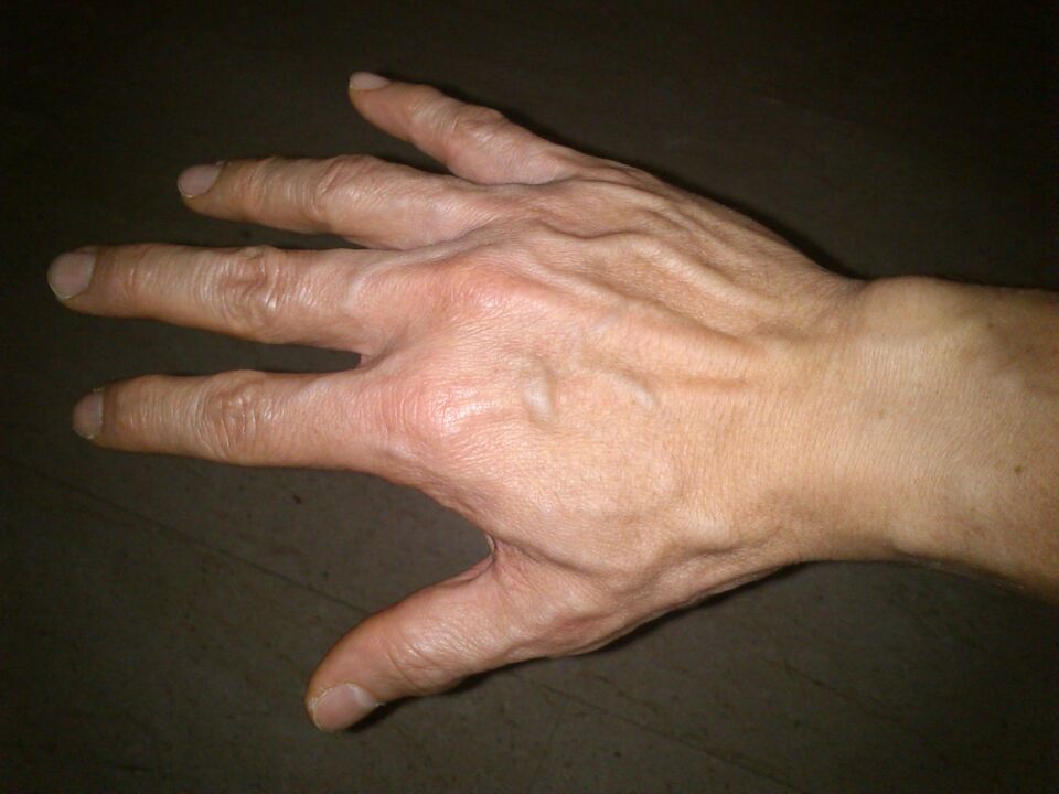 deformación dos ósos e dor nas articulacións dos dedos