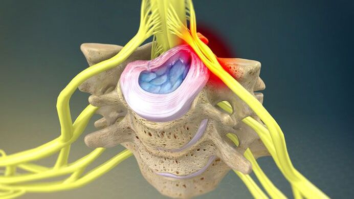 A protrusión do disco intervertebral é a causa da dor no pescozo