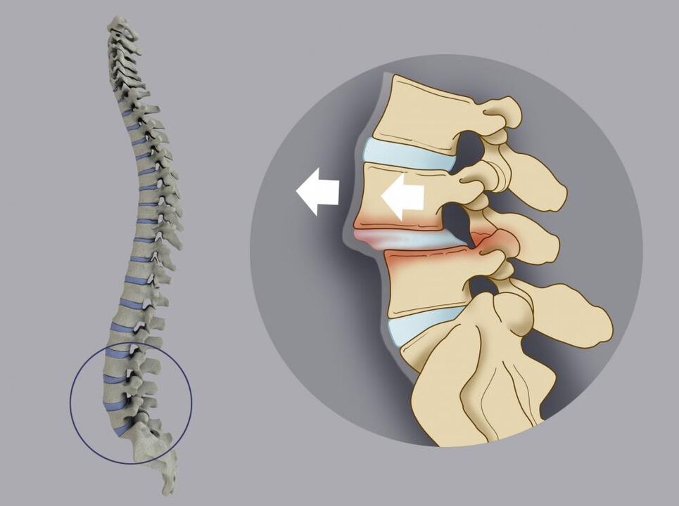 desprazamento das vértebras como causa da dor nas costas