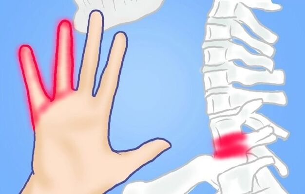 nervios pinchados como causa da dor nas costas